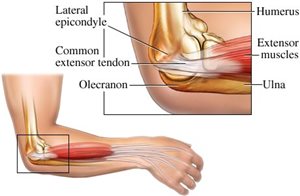 The Dreaded Tennis Elbow: The Impact of the Racquet 